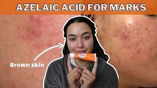 HOW TO FADE POST INFLAMMATORY HYPERPIGMENTATIONERYTHEMA WITH AZELAIC ACID SKINOREN 20 cream [upl. by Hareemas374]