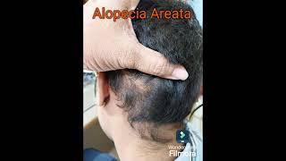 Cure Case Of Alopecia Areata [upl. by Pedrick627]