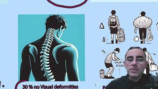 Scoliosis  Signs Symptoms Causes Treatments Myths and Facts [upl. by Hiasi]