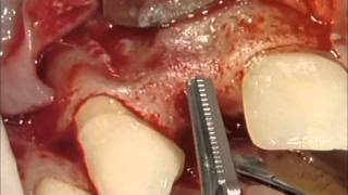 CAMLOG Implant Placement  Part 1  Surgery [upl. by Carmelo498]