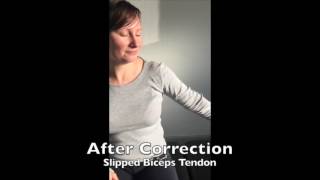 Slipped Biceps Tendon Correction [upl. by Ayekam]