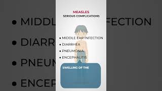 Complications from measles [upl. by Anjali145]