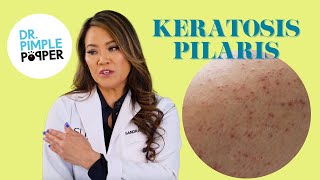 Ask Dr Pimple Popper  Keratosis Pilaris aka Chicken Skin [upl. by Meikah287]