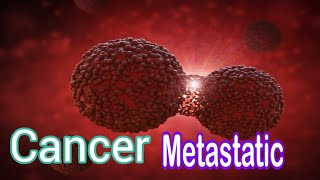 Cancer Metastatic  کینسر کا پھیلاؤ [upl. by Wakefield]