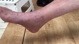 My trimalleolar fracture ORIF surgery and recovery as it happens [upl. by Aned]