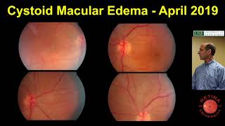 Cystoid Macular Edema [upl. by Adebayo]