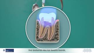 Endodontic Treatments  Danish version [upl. by Eima706]