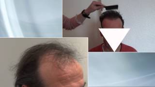 Example low density hair transplantation [upl. by Nile]