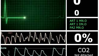 Hospital Monitor with FlatLine S SD [upl. by Nylazor]