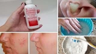 7 Surprising Uses for Hydrogen Peroxide [upl. by Aryamo]