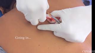 Sebaceous Cysts Removal  The Largest One to date [upl. by Viola874]