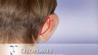 Otoplasty Ear Pinning at wwwPearsonFacescom [upl. by Kevon279]