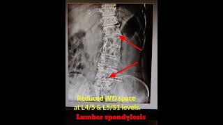 Lumber spondylosis x ray shortvideo [upl. by Yma]