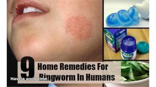 home remedies for ringworm [upl. by Dickey]