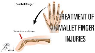 Mallet finger Treatment of this difficult finger injury [upl. by Niotna]