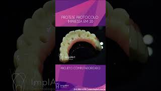 PRÓTESE PROTOCOLO SOBRE IMPLANTE DENTÁRIO COM COMPUTAÇÃO GRAFICA E IMPRESSORA 3D  Clínica ImplArt [upl. by Nallak188]