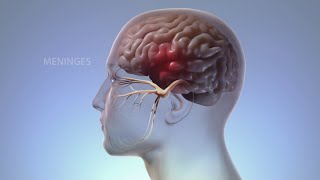 What Happens In Your Body During Migraine  WebMD [upl. by Rufus]