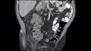 Dedifferentiated liposarcoma mimicking a primary colon mass  CT scan [upl. by Sharpe381]