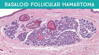 Basaloid Follicular Hamartoma linear multiple  mimic of basal cell carcinoma pathology dermpath [upl. by Moreland]