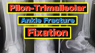 Pilon Trimalleolar Fracture Fixation [upl. by Julis]