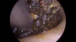 Blocked Ear Removal Extraction by Ear Wax Removal Specialist Mr Raithatha Ep 287 [upl. by Anada]