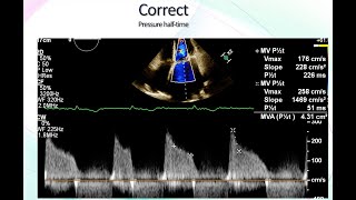 Mitral Stenosis Echocardiographic Assessment [upl. by Ahsel]