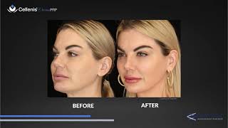 Cellenis Derma PRP Before amp After Pictures [upl. by Yezdnil]