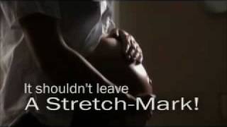 Stretch Marks After Pregnancy [upl. by Ibrab]