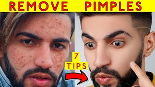 How to Remove Pimples amp Acne Naturally at Home with 7 Daily Skin Care Routine Tips Hindi [upl. by Demha]