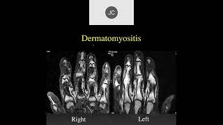 MRI of the Wrist Part 15  Wrist Inflammation [upl. by Anahpos452]