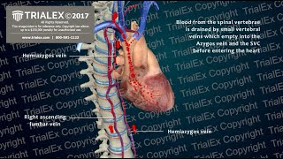 The Mechanism of DIC  Disseminated Intravascular Coagulation [upl. by Eliga]