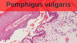 Pemphigus Vulgaris  Pathology mini tutorial [upl. by Idna]