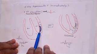 ECG 7  Myocardial infraction  ECG changes in MI and their mechanism [upl. by Cho]