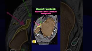 Essential What Does an Ankle Sprain Look Like on MRI [upl. by Elyad487]