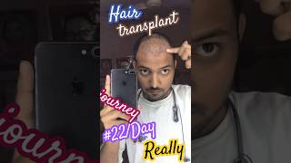 22day result hair transplant journey Comment Reply viralreelsinstagram video viralyoutuber [upl. by Powel563]