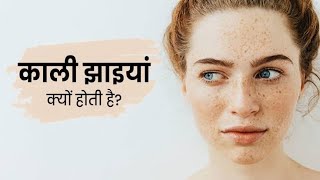 चेहरे की झाई  remove pigmentation  remedy of melasma  elocon cream  Freckles face  Jhaiya [upl. by Elazaro]