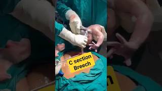 c sectionbreech deliverybaby birthshortsvideo [upl. by Nitsed397]