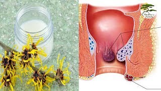 How to Use Witch Hazel to Kill Hemorrhoids  You can say goodbye hemorrhoids [upl. by Inaja]