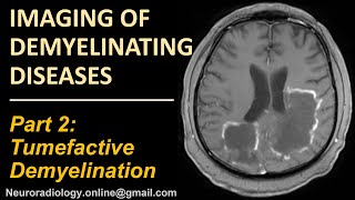 Imaging of Tumefactive Demyelination [upl. by Trbor324]