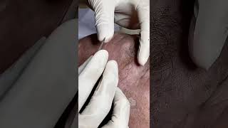 Blackhead Removal for Elderly Woman Gentle and Effective Extraction [upl. by Leak561]