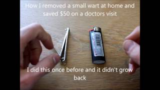 Removing wart with nail clippers and bic lighter Saved 50 in 2 minutes [upl. by Irita858]