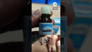 duofilm lotion for warts corn calluses [upl. by Nae]