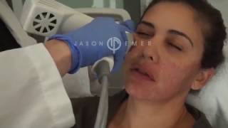 Syneron Profound Microneedling with Radiofrequency  Skin Facial Tightening and Lifting [upl. by Htebesile670]