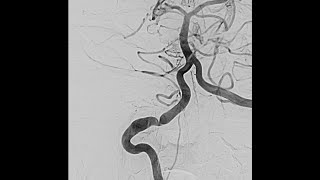 Vertebral Artery Web [upl. by Josephson]