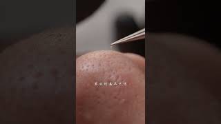 Lets relax her skin blackheads acne pores cleaning [upl. by Breed953]