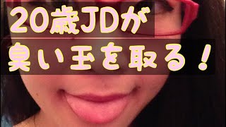 臭い玉を取る動画2 ［Tonsil stones］ [upl. by Noemis]