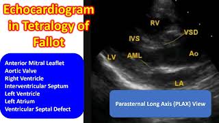 Echocardiogram in Tetralogy of Fallot [upl. by Mcdowell819]