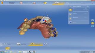 CEREC Fixing Upper Implant Central Incisor Design [upl. by Alyehs259]