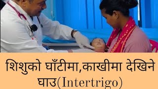 शिशुको घाँटीमाकाखीमा देखिने घाउIntertrigoDr Kishor Khatry swasthyapharmacy health healthtips [upl. by Itnaihc267]