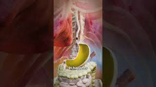 Acid Reflux Explained 🔥🤔 Causes Symptoms and Treatments [upl. by Naujyt573]